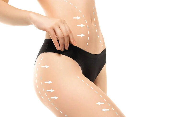 - carboxiterapia